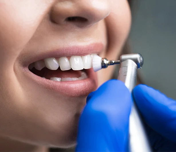Fluoride treatment