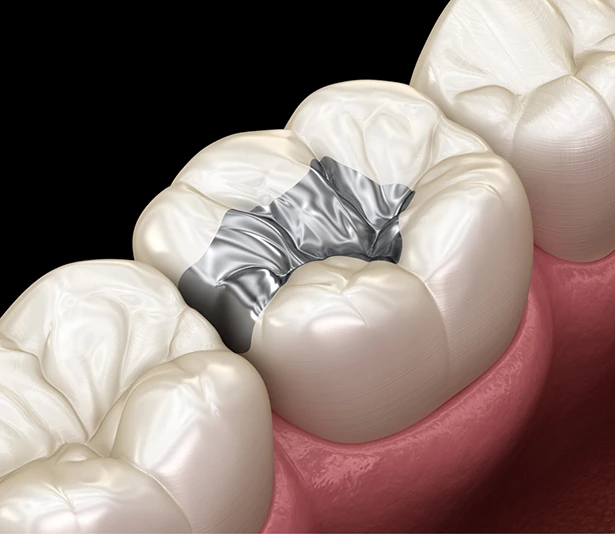 Dental sealants