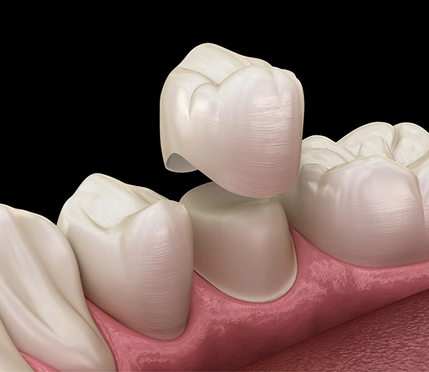 Dental crown