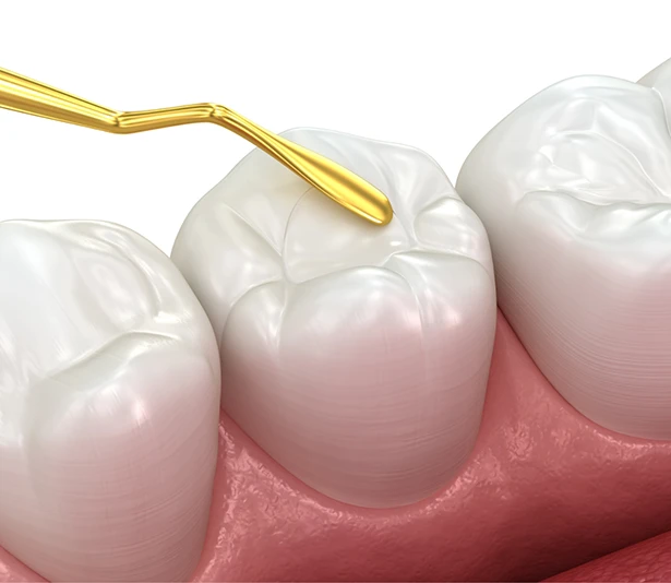 Tooth-colored fillings